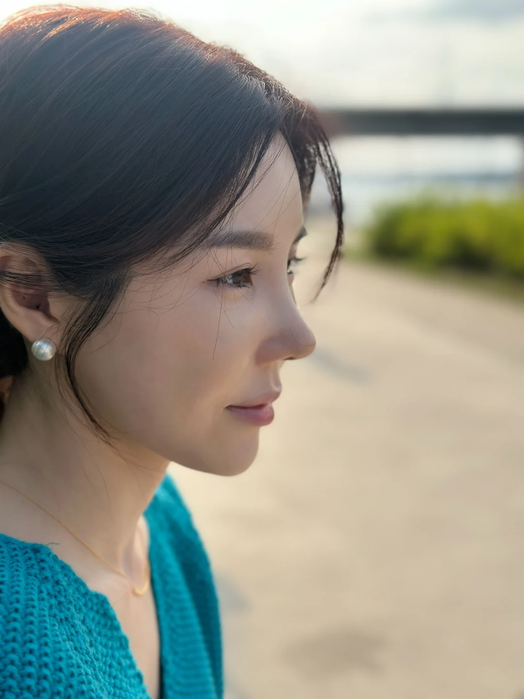 Rib-cartilage rhinoplasty: recovery through six months · Case 022 at Answer Plastic Surgery. Profile view during rhinoplasty recovery — 2 weeks at Answer Plastic Surgery.