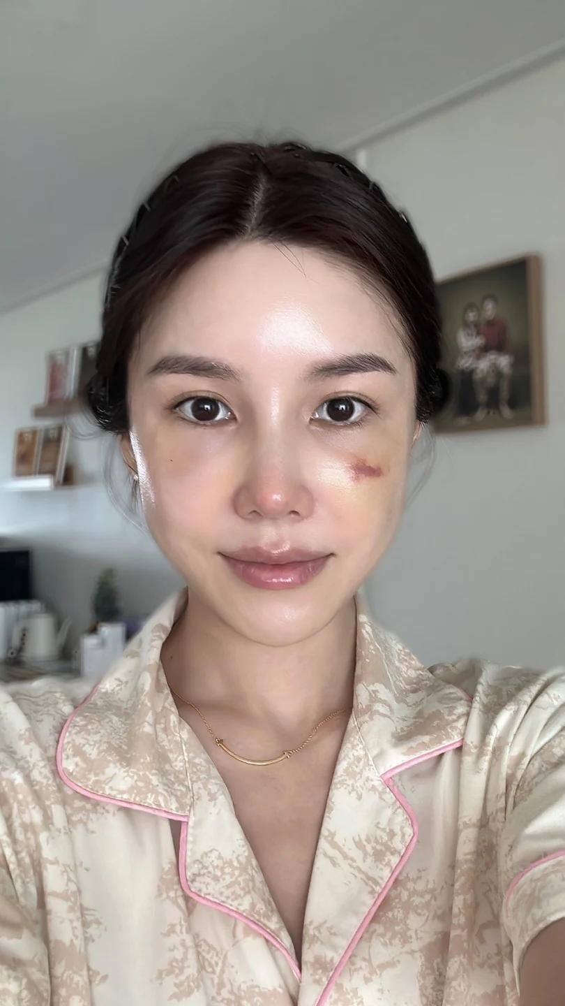 Rib-cartilage rhinoplasty: recovery through six months · Case 022 at Answer Plastic Surgery. Front view during rhinoplasty recovery — 2 weeks at Answer Plastic Surgery.