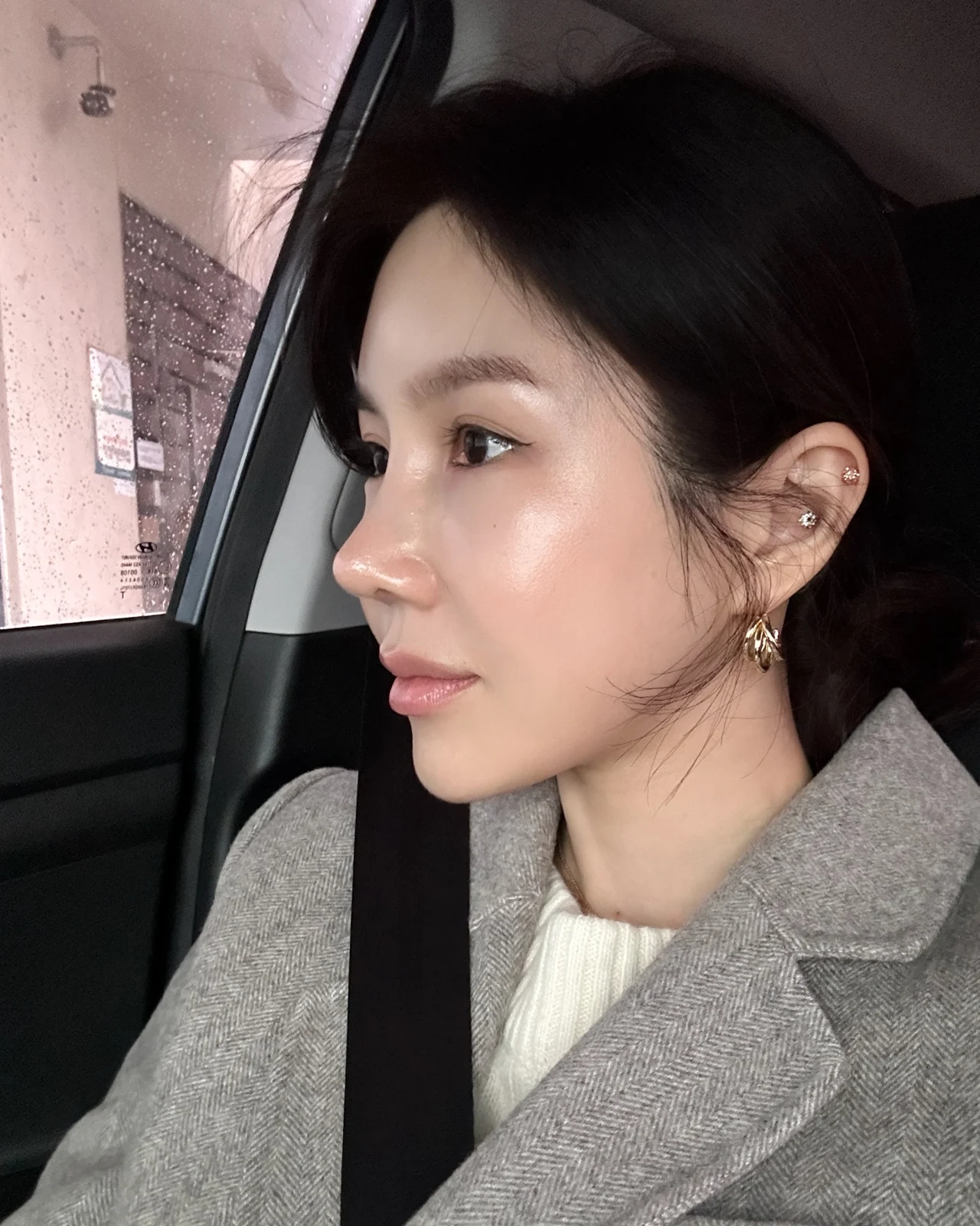 Rib-cartilage rhinoplasty: recovery through six months · Case 022 at Answer Plastic Surgery. Later oblique photograph after rhinoplasty — 6 months at Answer Plastic Surgery.