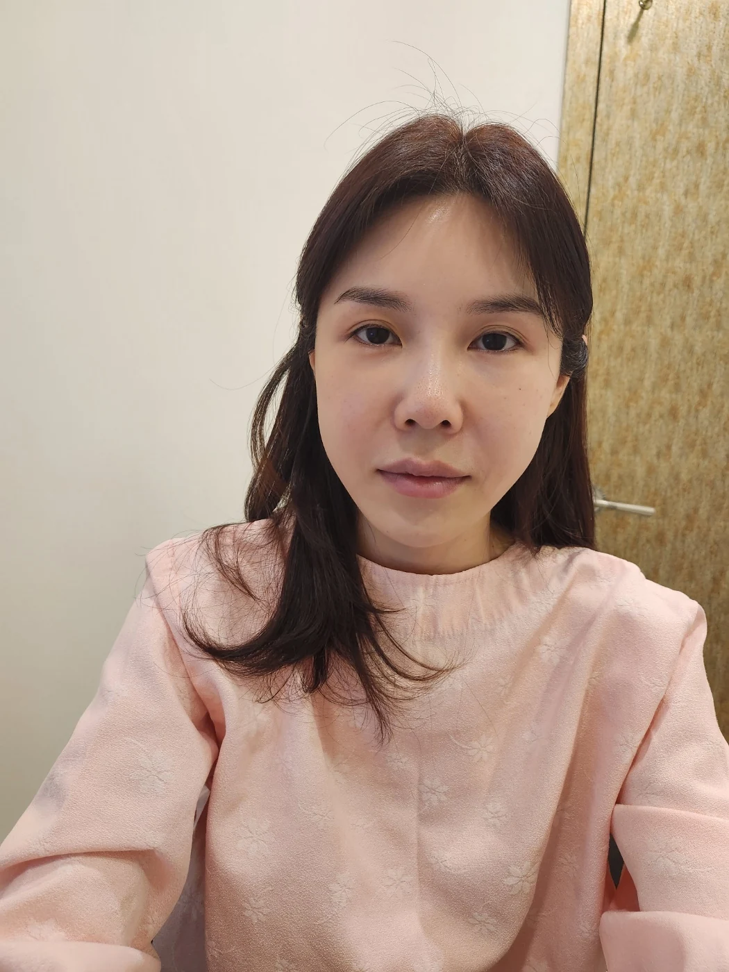 Rib-cartilage rhinoplasty: recovery through six months · Case 022 at Answer Plastic Surgery. Front view of the nose — before at Answer Plastic Surgery.