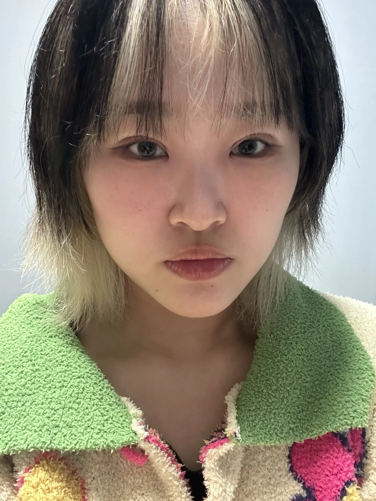 Eye-area surgery: recovery through one month · Case 041 at Answer Plastic Surgery. One month: front view of the eye area, supplied by Answer Plastic Surgery for case ANS-041.