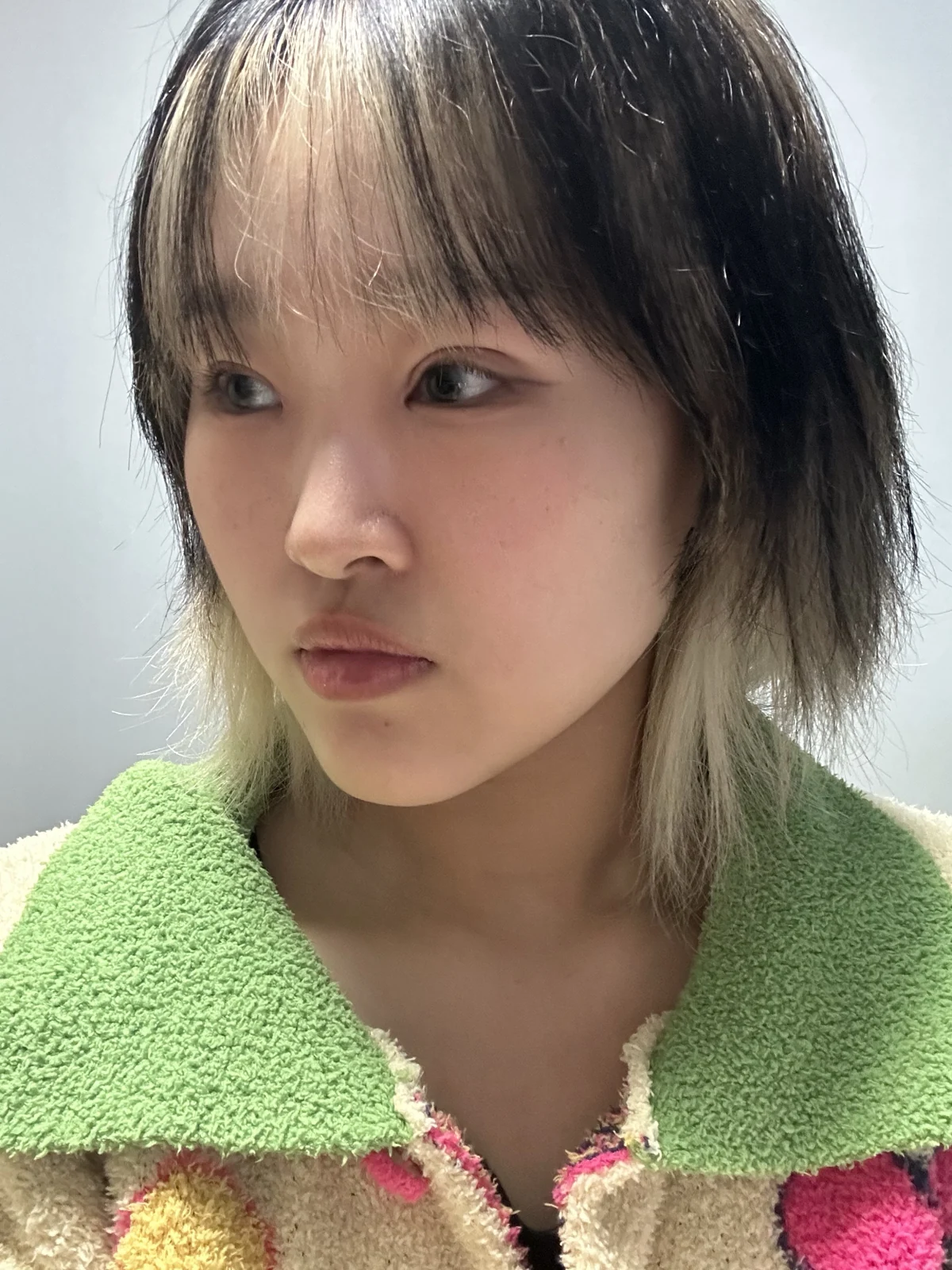 Eye-area surgery: recovery through one month · Case 041 at Answer Plastic Surgery. One month: angled view of the eye area, supplied by Answer Plastic Surgery for case ANS-041.