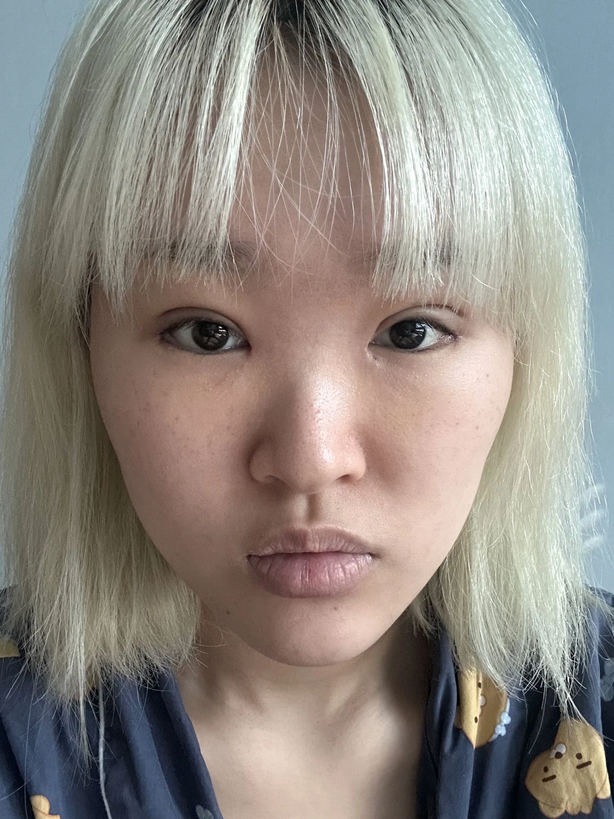 Eye-area surgery: recovery through one month · Case 041 at Answer Plastic Surgery. Two weeks: front view of the eye area, supplied by Answer Plastic Surgery for case ANS-041.