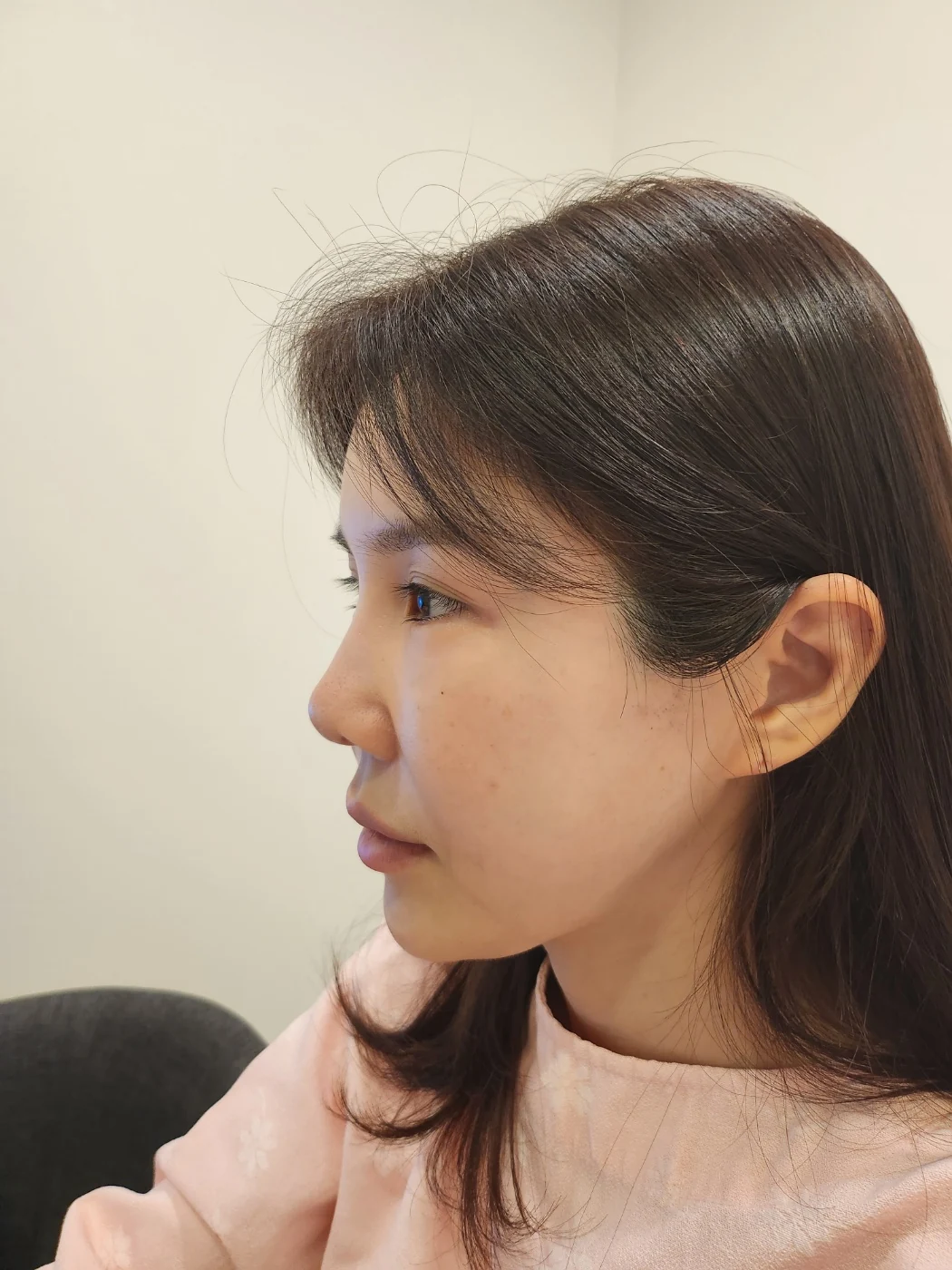 Rib-cartilage rhinoplasty: recovery through six months · Case 022 at Answer Plastic Surgery. Profile view of the nose — before at Answer Plastic Surgery.