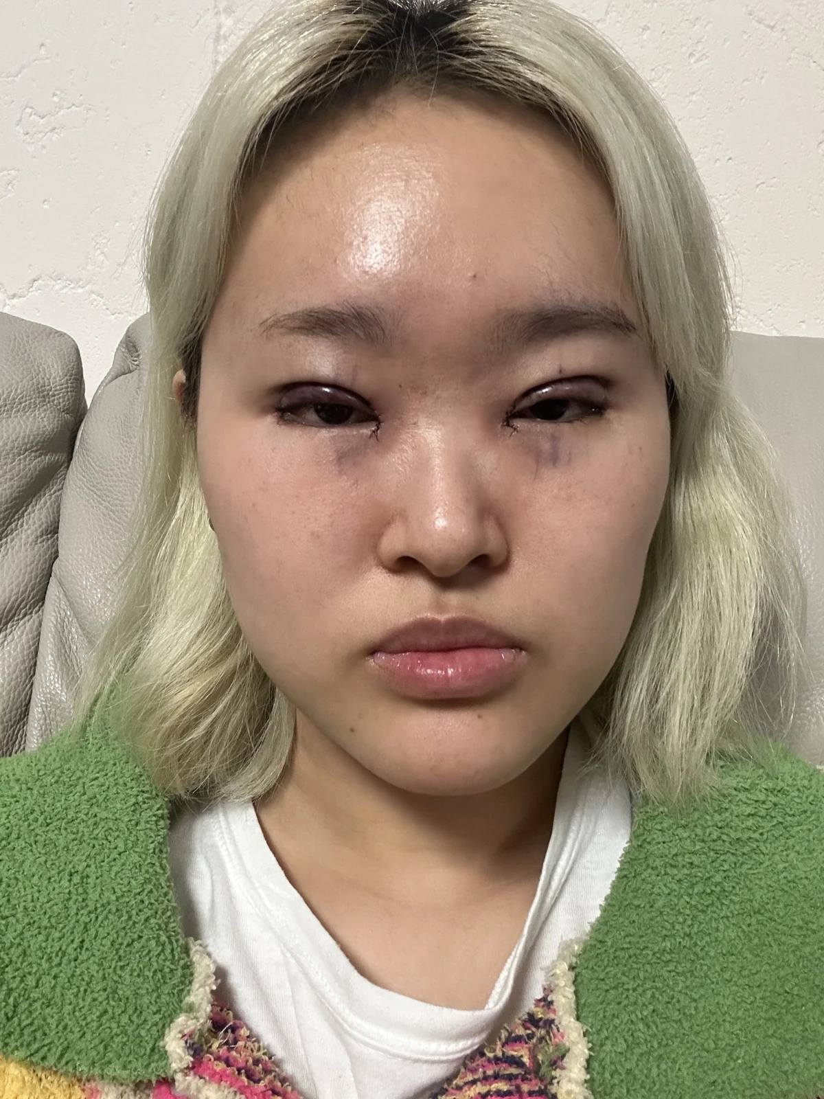 Eye-area surgery: recovery through one month · Case 041 at Answer Plastic Surgery. Surgery day: front view of the eye area, supplied by Answer Plastic Surgery for case ANS-041.