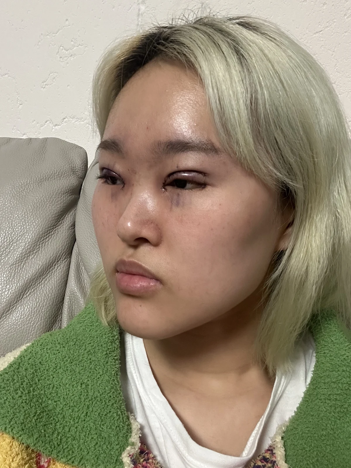 Eye-area surgery: recovery through one month · Case 041 at Answer Plastic Surgery. Surgery day: angled view of the eye area, supplied by Answer Plastic Surgery for case ANS-041.