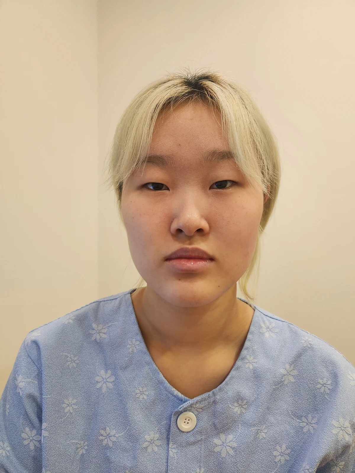 Eye-area surgery: recovery through one month · Case 041 at Answer Plastic Surgery. Before: front view of the eye area, supplied by Answer Plastic Surgery for case ANS-041.