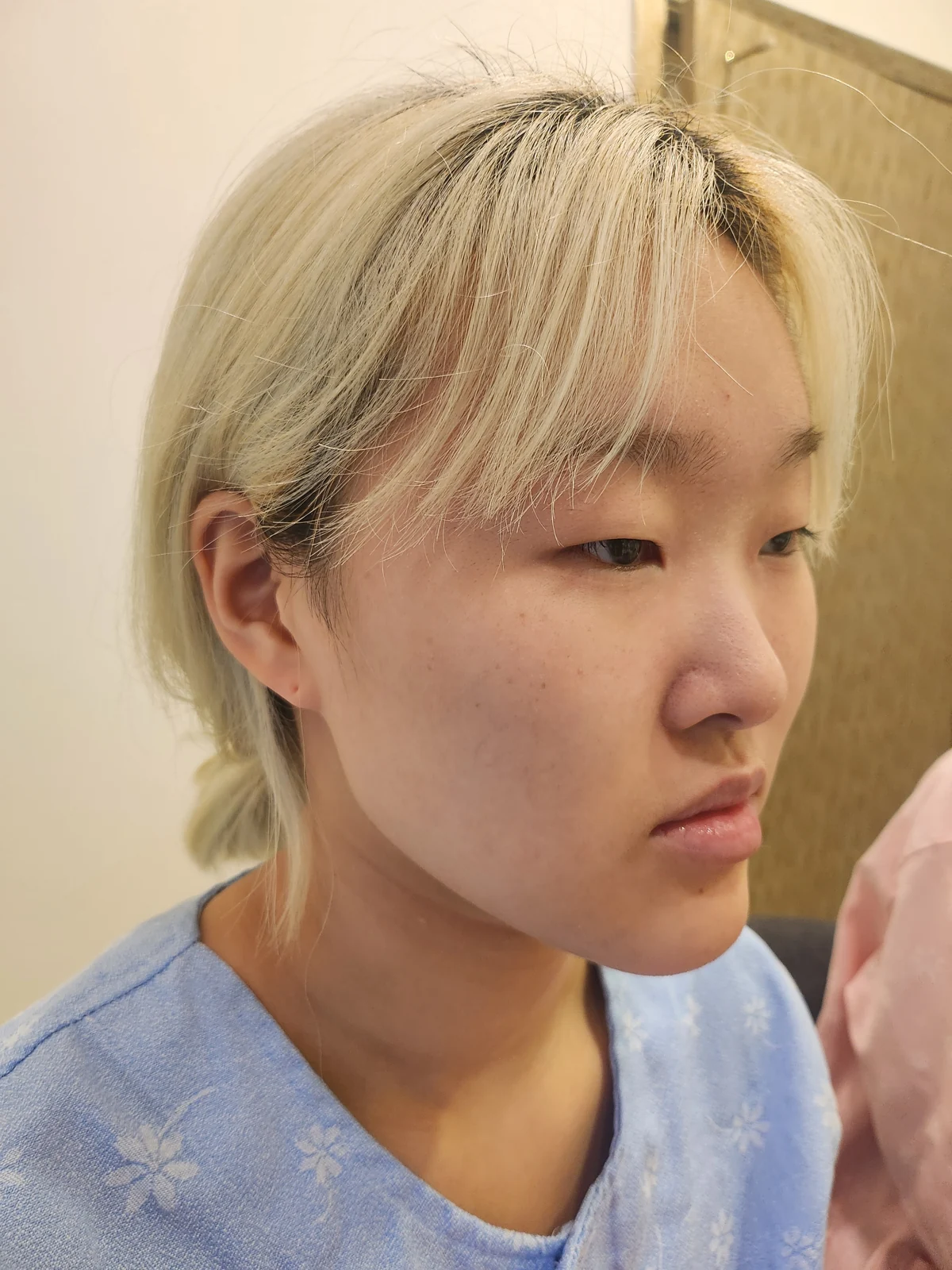 Eye-area surgery: recovery through one month · Case 041 at Answer Plastic Surgery. Before: angled view of the eye area, supplied by Answer Plastic Surgery for case ANS-041.