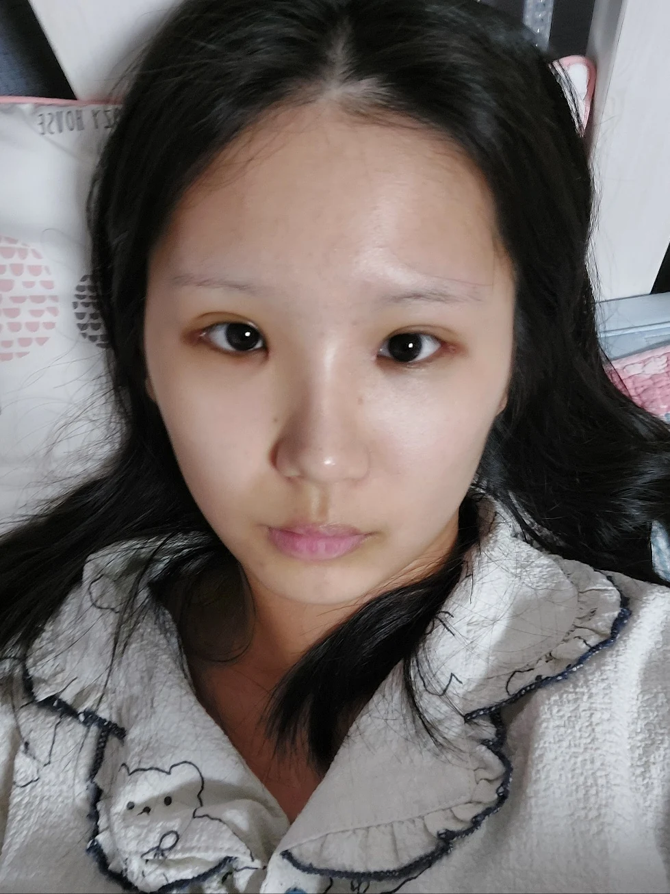 Eye-area surgery: one-week to two-month photographs · Case 042 at Answer Plastic Surgery. One month: front view of the eye area, supplied by Answer Plastic Surgery for case ANS-042.