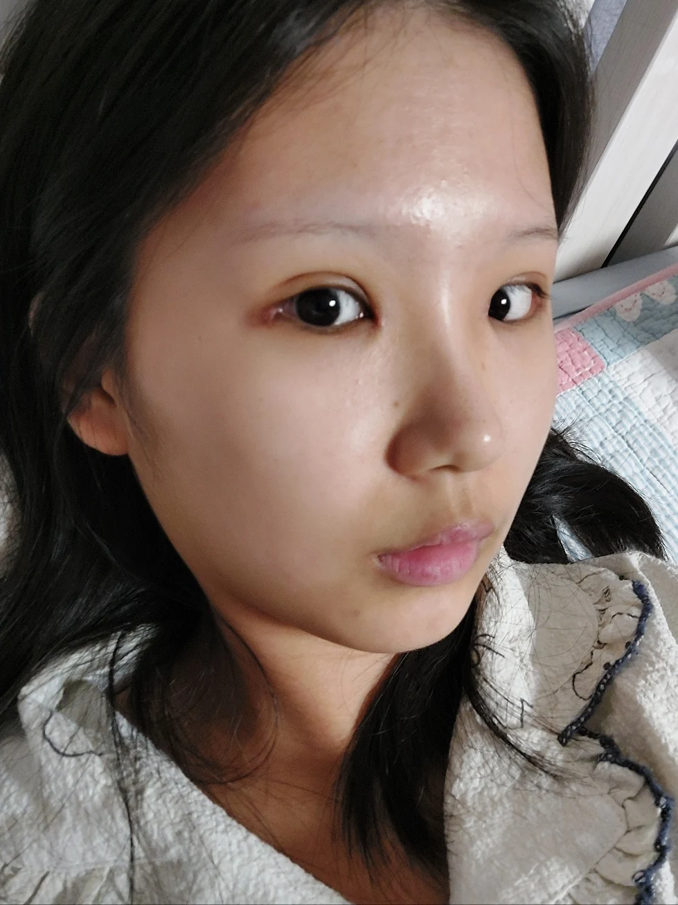 Eye-area surgery: one-week to two-month photographs · Case 042 at Answer Plastic Surgery. One month: angled view of the eye area, supplied by Answer Plastic Surgery for case ANS-042.