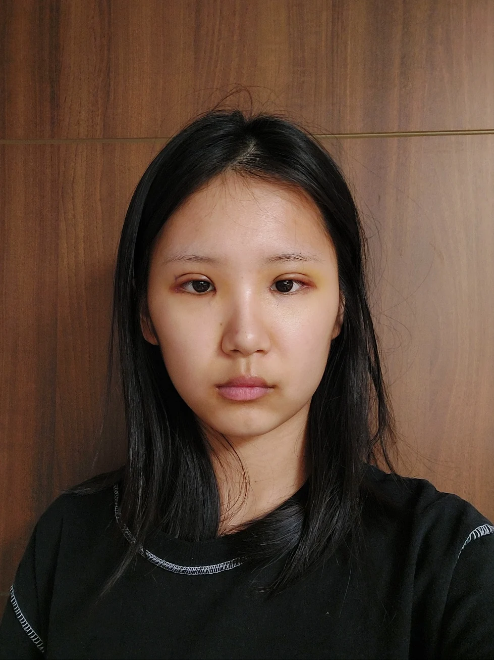 Eye-area surgery: one-week to two-month photographs · Case 042 at Answer Plastic Surgery. One week: front view of the eye area, supplied by Answer Plastic Surgery for case ANS-042.