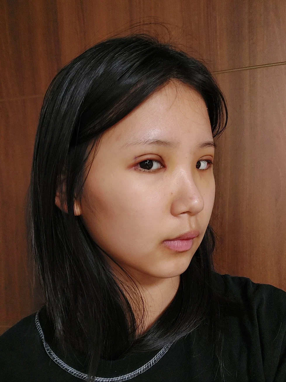 Eye-area surgery: one-week to two-month photographs · Case 042 at Answer Plastic Surgery. One week: angled view of the eye area, supplied by Answer Plastic Surgery for case ANS-042.