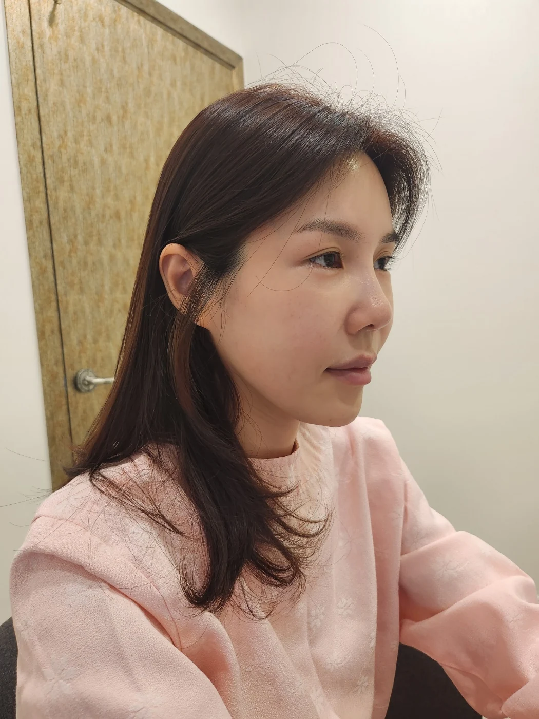 Rib-cartilage rhinoplasty: recovery through six months · Case 022 at Answer Plastic Surgery. Opposite oblique view of the nose — before at Answer Plastic Surgery.