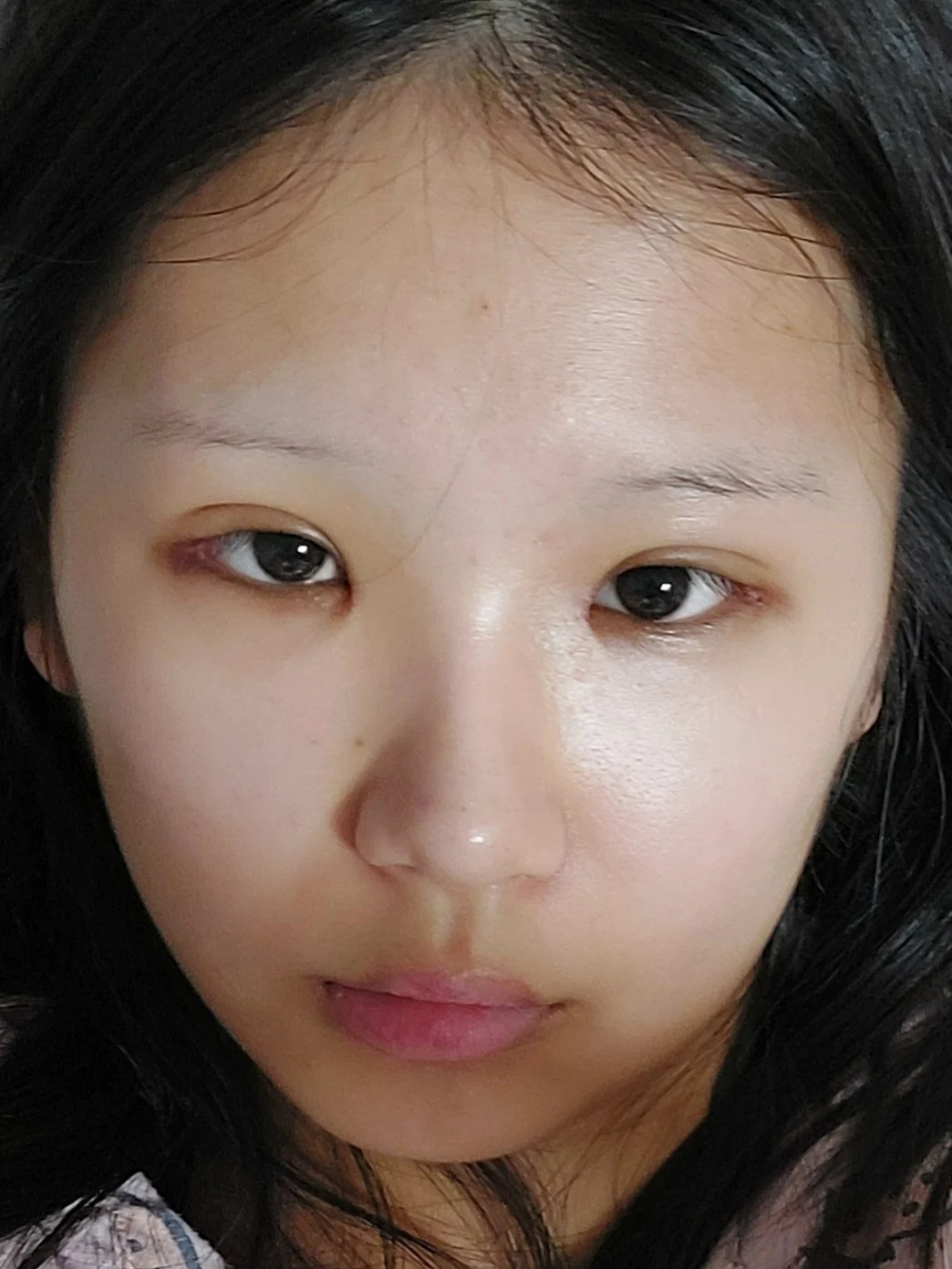 Eye-area surgery: one-week to two-month photographs · Case 042 at Answer Plastic Surgery. Three weeks: front view of the eye area, supplied by Answer Plastic Surgery for case ANS-042.