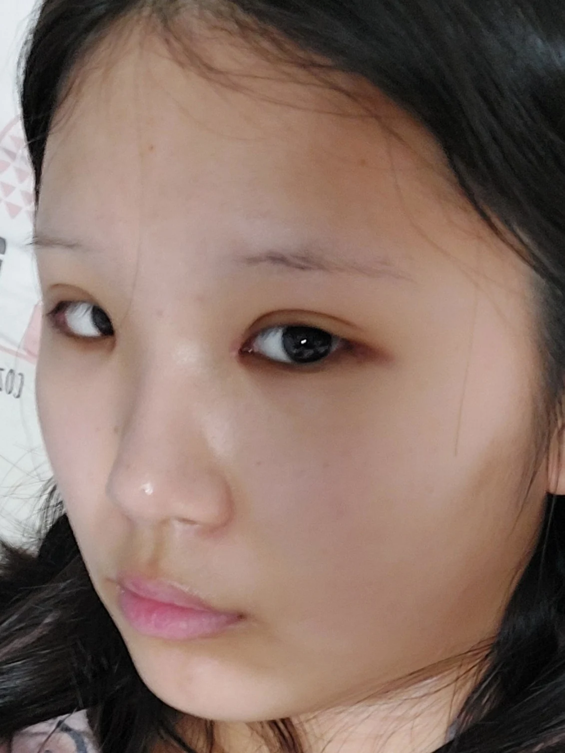 Eye-area surgery: one-week to two-month photographs · Case 042 at Answer Plastic Surgery. Three weeks: angled view of the eye area, supplied by Answer Plastic Surgery for case ANS-042.