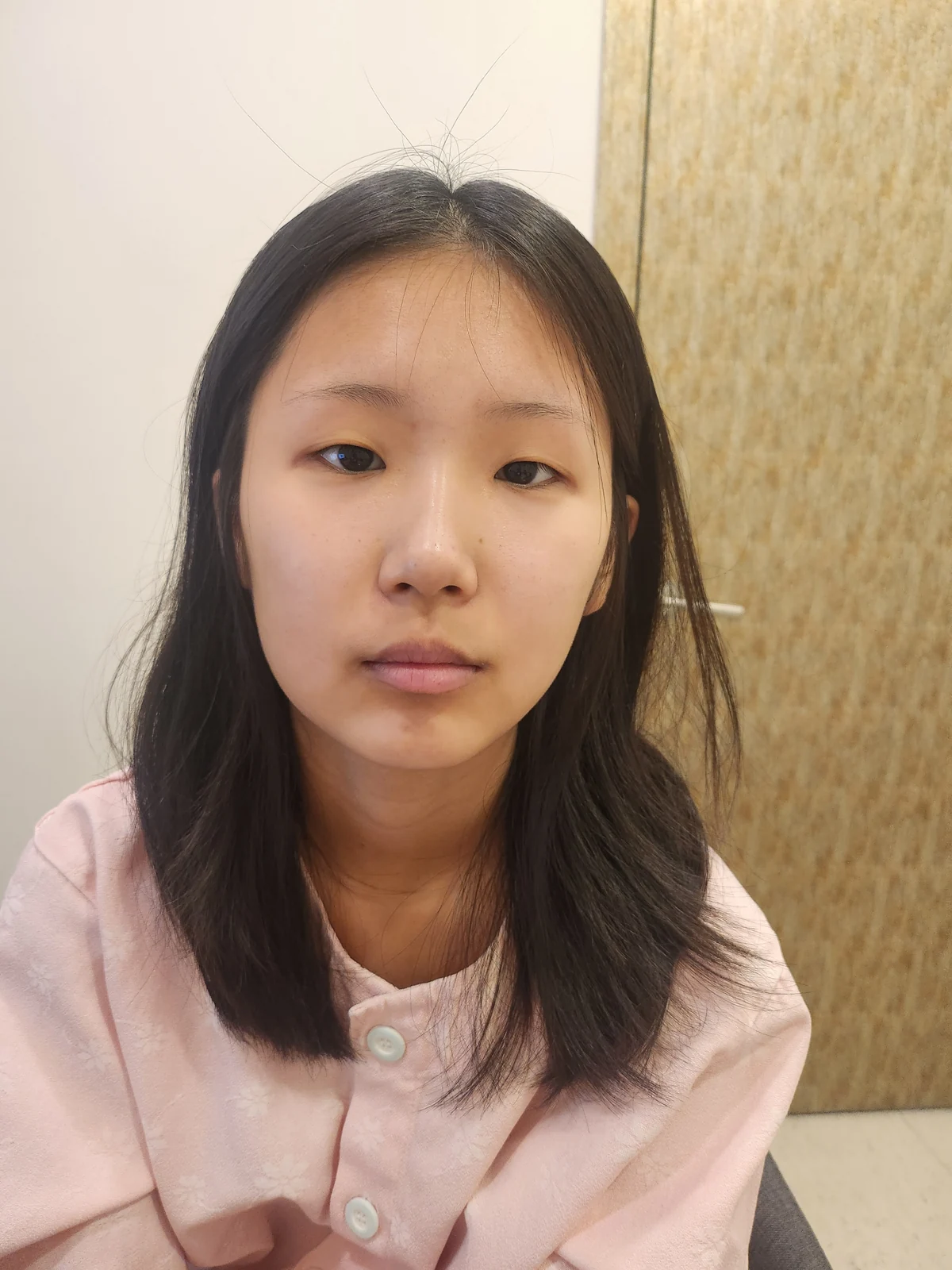 Eye-area surgery: one-week to two-month photographs · Case 042 at Answer Plastic Surgery. Before: front view of the eye area, supplied by Answer Plastic Surgery for case ANS-042.