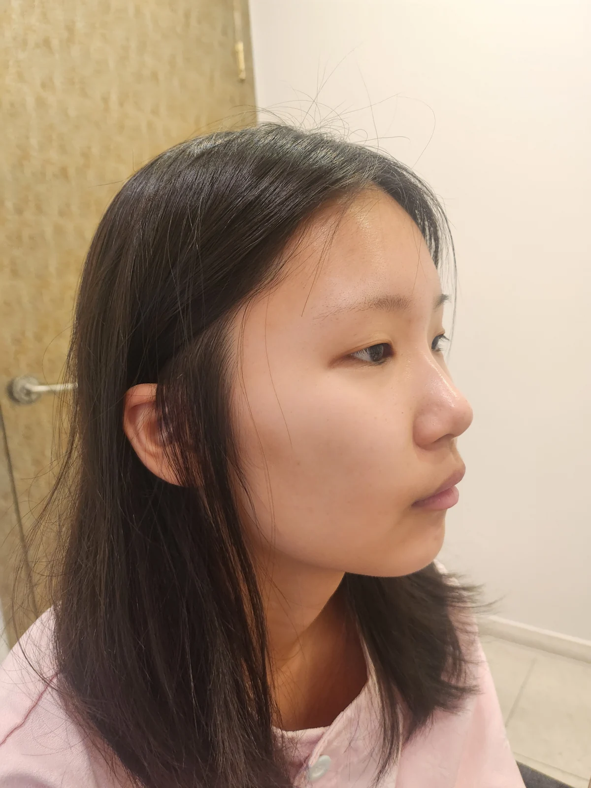 Eye-area surgery: one-week to two-month photographs · Case 042 at Answer Plastic Surgery. Before: angled view of the eye area, supplied by Answer Plastic Surgery for case ANS-042.