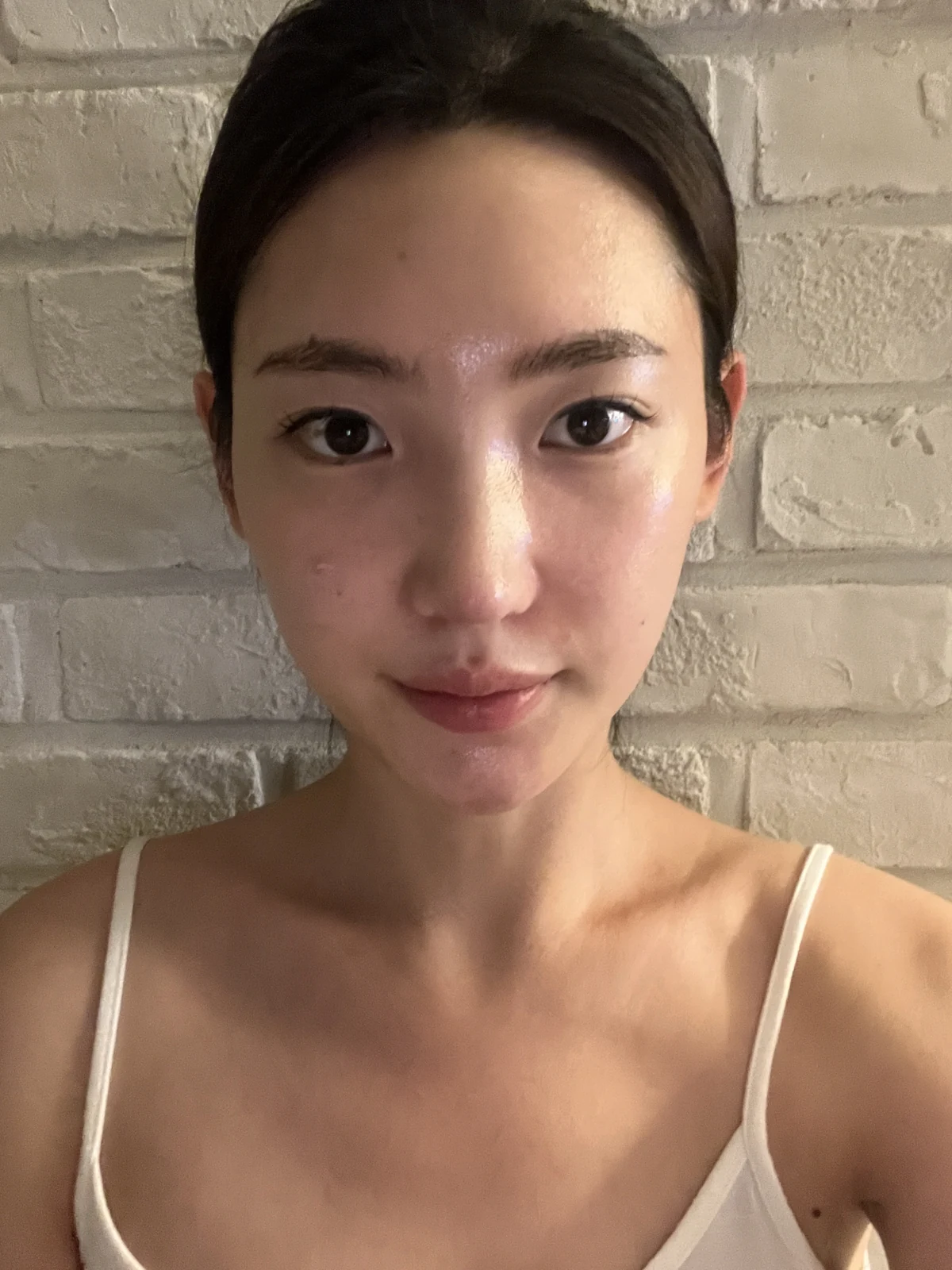 Facial before-and-after photographs through two months · Case 023 at Answer Plastic Surgery. Front view in the follow-up sequence — 1 week at Answer Plastic Surgery.