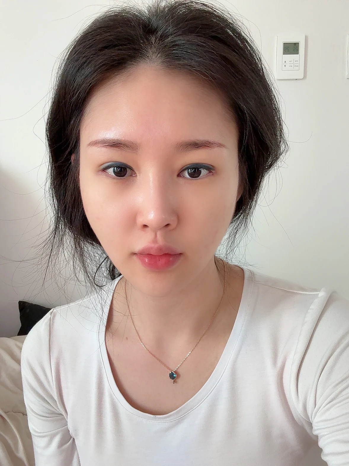 Revision double-eyelid surgery and Wonder canthoplasty: three-month follow-up · Case 043 at Answer Plastic Surgery. Two weeks: front view of the eye area, supplied by Answer Plastic Surgery for case ANS-043.