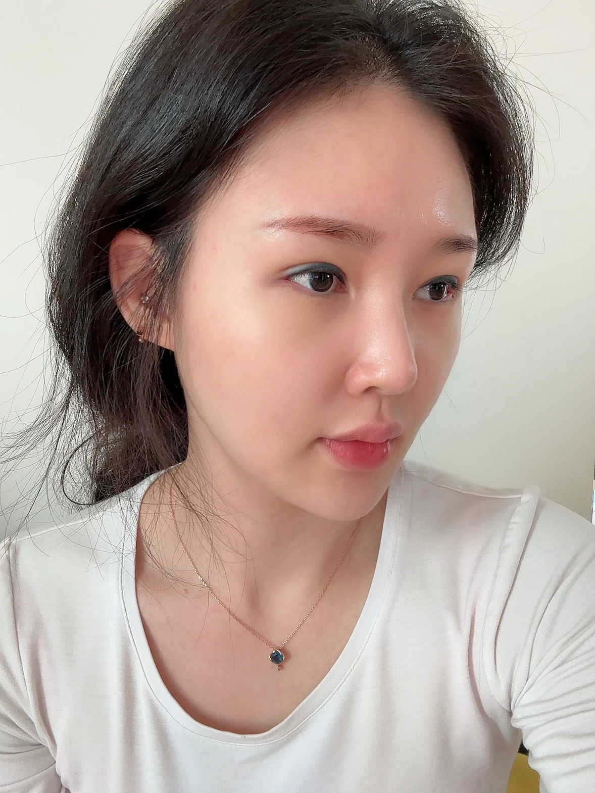 Revision double-eyelid surgery and Wonder canthoplasty: three-month follow-up · Case 043 at Answer Plastic Surgery. Two weeks: angled view of the eye area, supplied by Answer Plastic Surgery for case ANS-043.