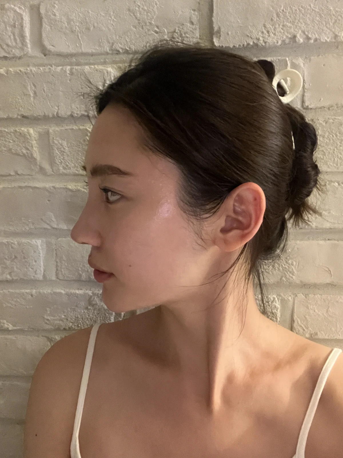 Facial before-and-after photographs through two months · Case 023 at Answer Plastic Surgery. Profile view in the follow-up sequence — 1 week at Answer Plastic Surgery.