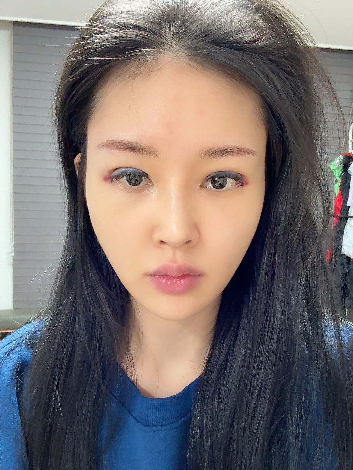 Revision double-eyelid surgery and Wonder canthoplasty: three-month follow-up · Case 043 at Answer Plastic Surgery. Surgery day: front view of the eye area, supplied by Answer Plastic Surgery for case ANS-043.