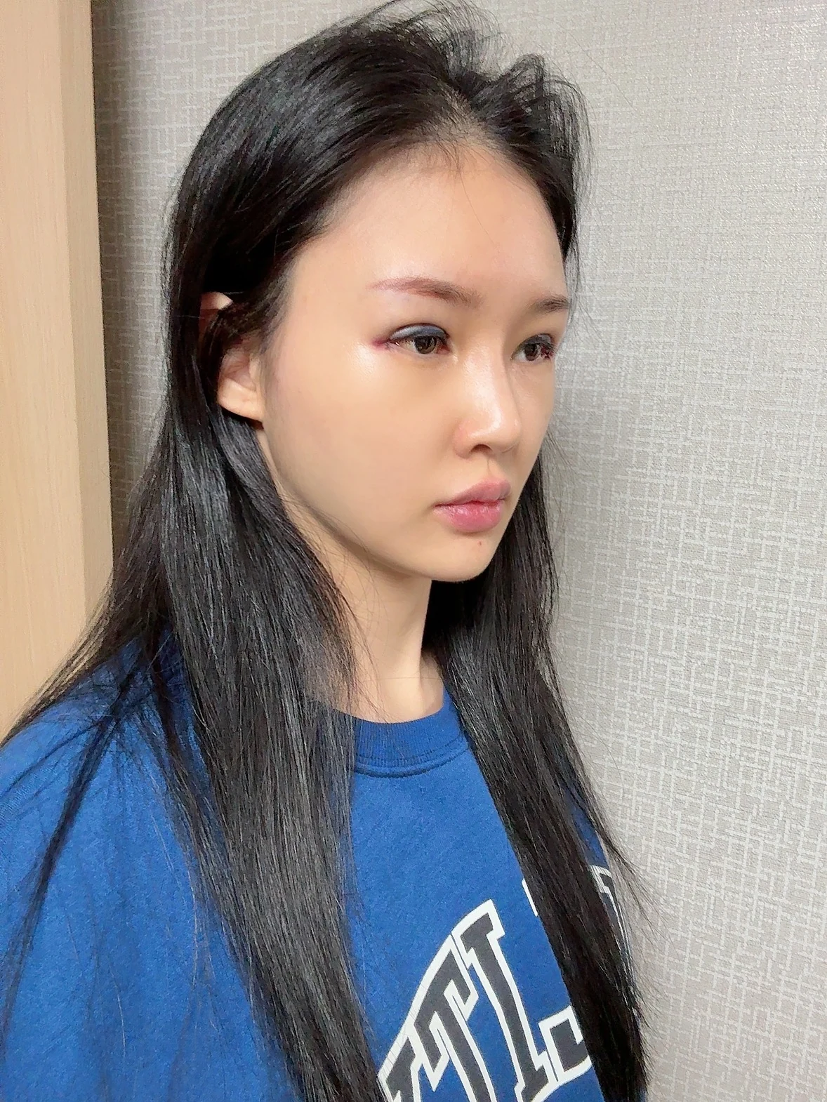 Revision double-eyelid surgery and Wonder canthoplasty: three-month follow-up · Case 043 at Answer Plastic Surgery. Surgery day: angled view of the eye area, supplied by Answer Plastic Surgery for case ANS-043.