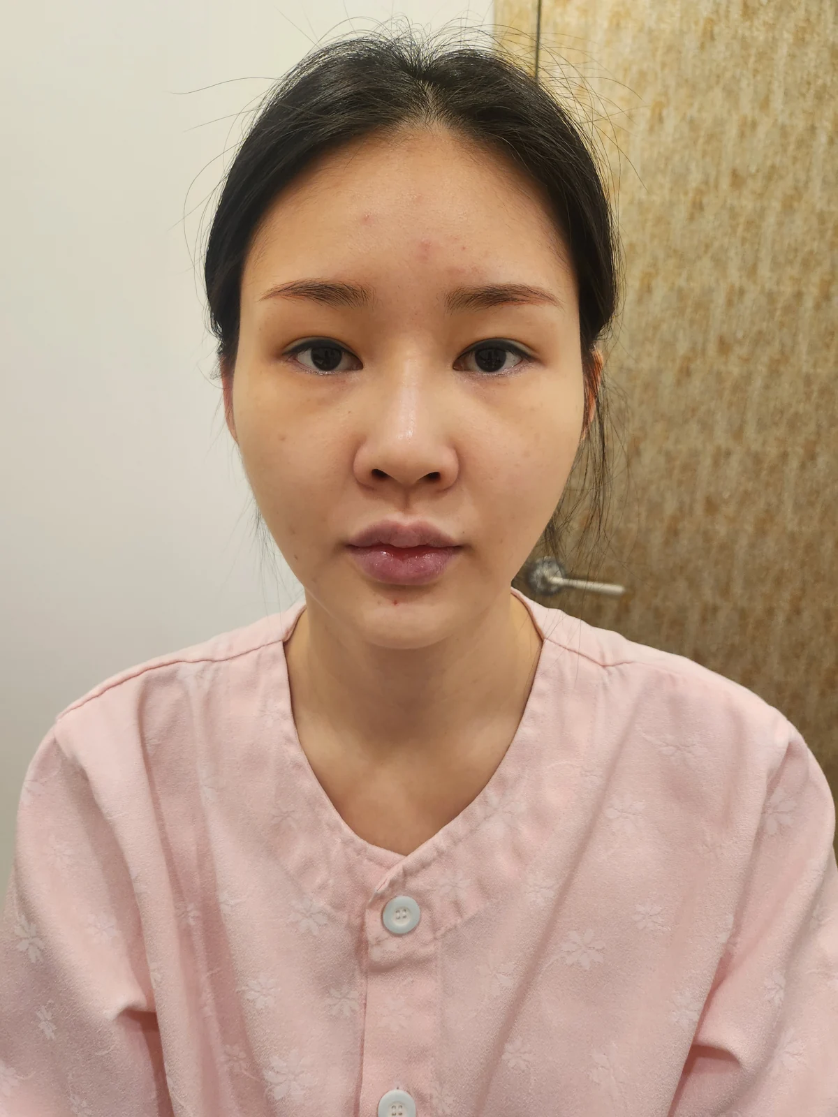 Revision double-eyelid surgery and Wonder canthoplasty: three-month follow-up · Case 043 at Answer Plastic Surgery. Before: front view of the eye area, supplied by Answer Plastic Surgery for case ANS-043.