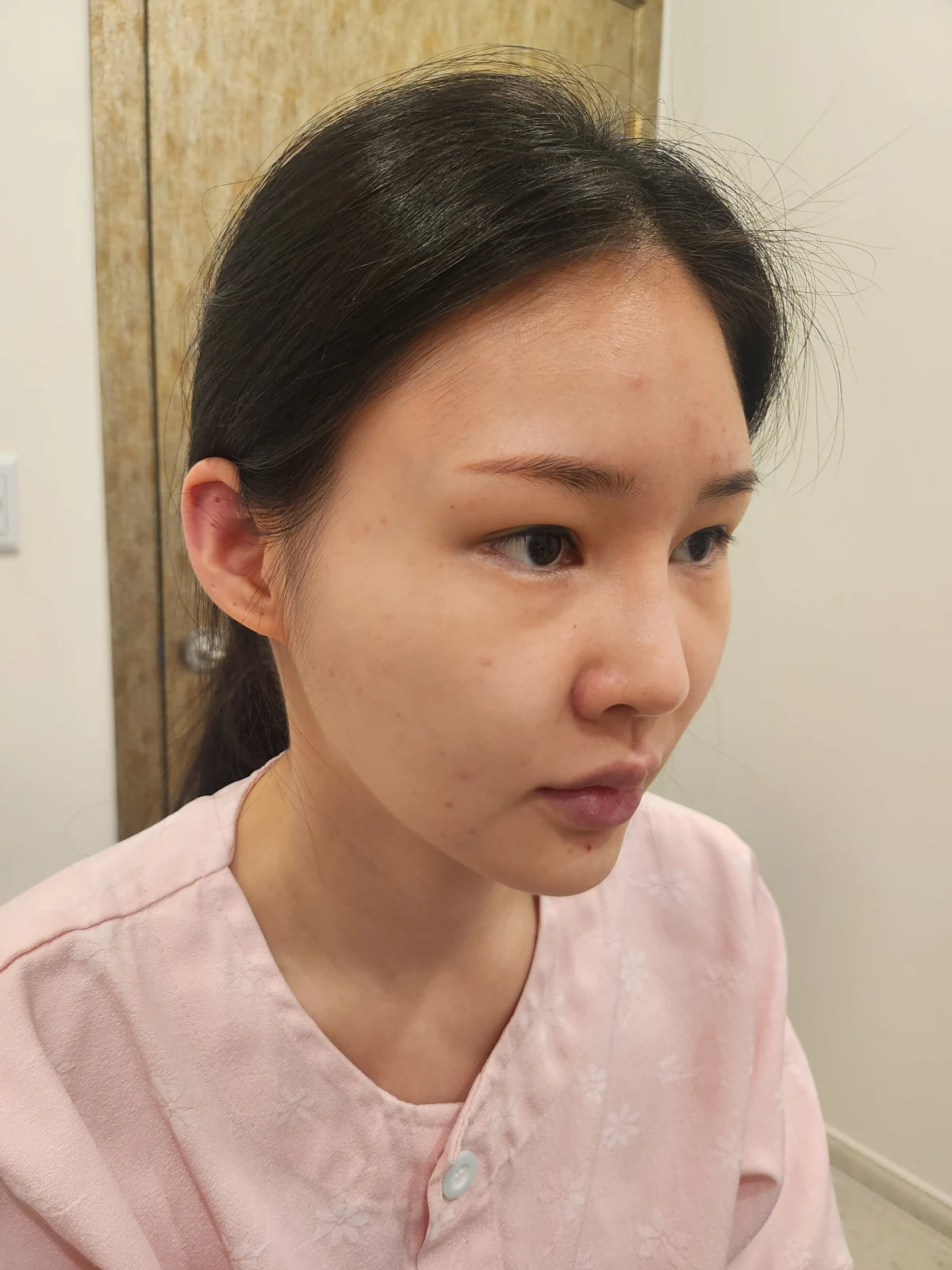 Revision double-eyelid surgery and Wonder canthoplasty: three-month follow-up · Case 043 at Answer Plastic Surgery. Before: angled view of the eye area, supplied by Answer Plastic Surgery for case ANS-043.