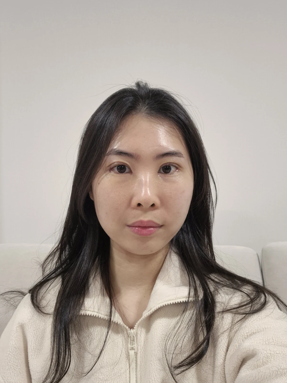 Double-eyelid surgery with canthoplasty and ptosis correction: two-month sequence · Case 044 at Answer Plastic Surgery. One week: front view of the eye area, supplied by Answer Plastic Surgery for case ANS-044.
