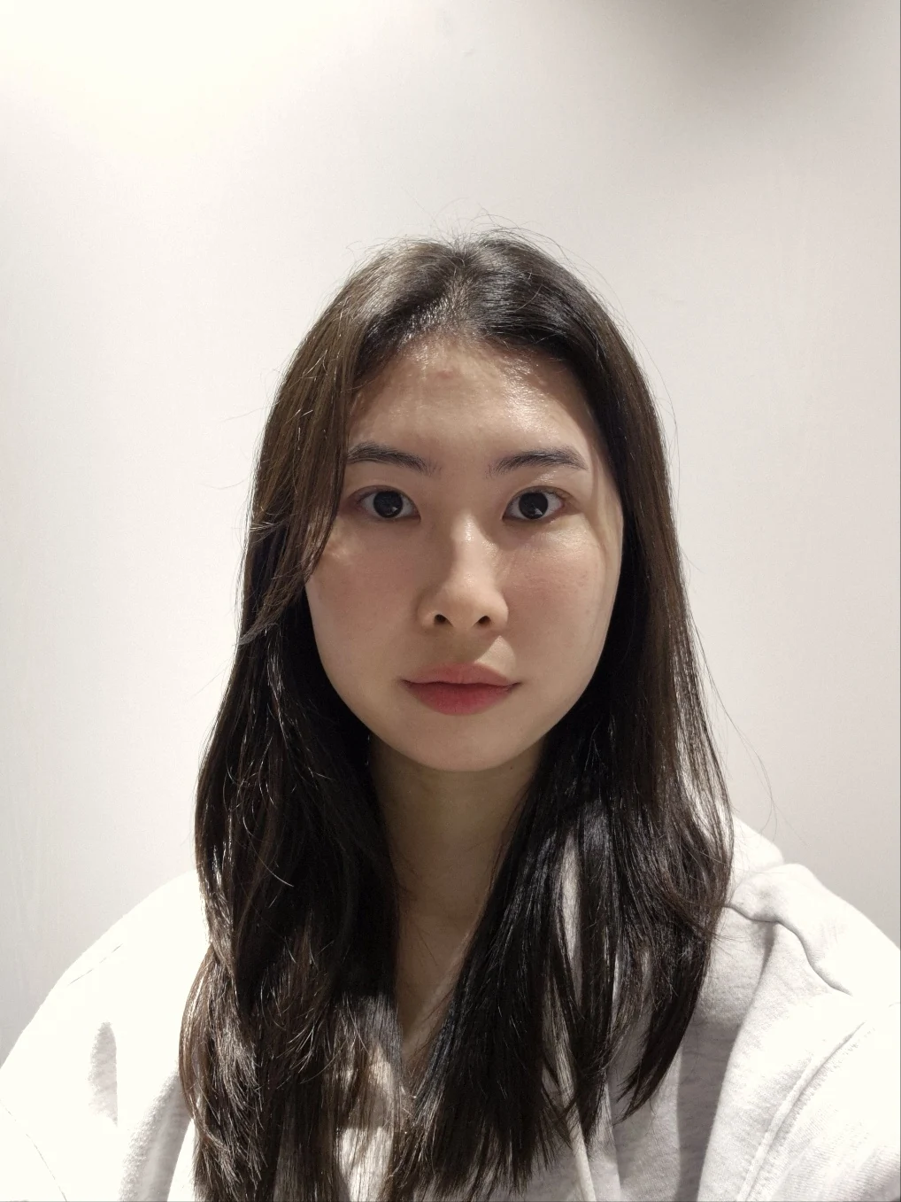Double-eyelid surgery with canthoplasty and ptosis correction: two-month sequence · Case 044 at Answer Plastic Surgery. Two months: front view of the eye area, supplied by Answer Plastic Surgery for case ANS-044.