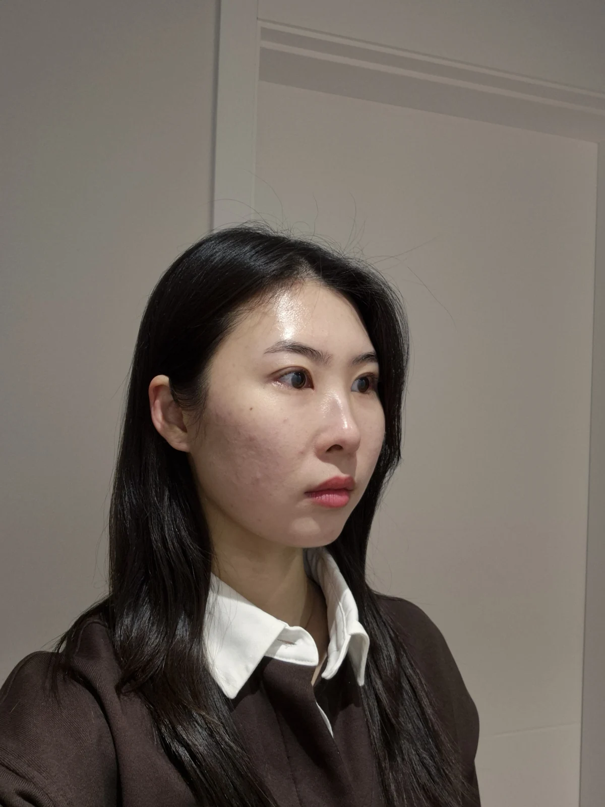 Double-eyelid surgery with canthoplasty and ptosis correction: two-month sequence · Case 044 at Answer Plastic Surgery. Three weeks: angled view of the eye area, supplied by Answer Plastic Surgery for case ANS-044.