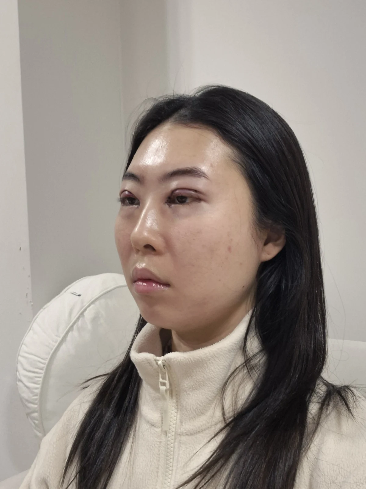 Double-eyelid surgery with canthoplasty and ptosis correction: two-month sequence · Case 044 at Answer Plastic Surgery. Surgery day: angled view of the eye area, supplied by Answer Plastic Surgery for case ANS-044.