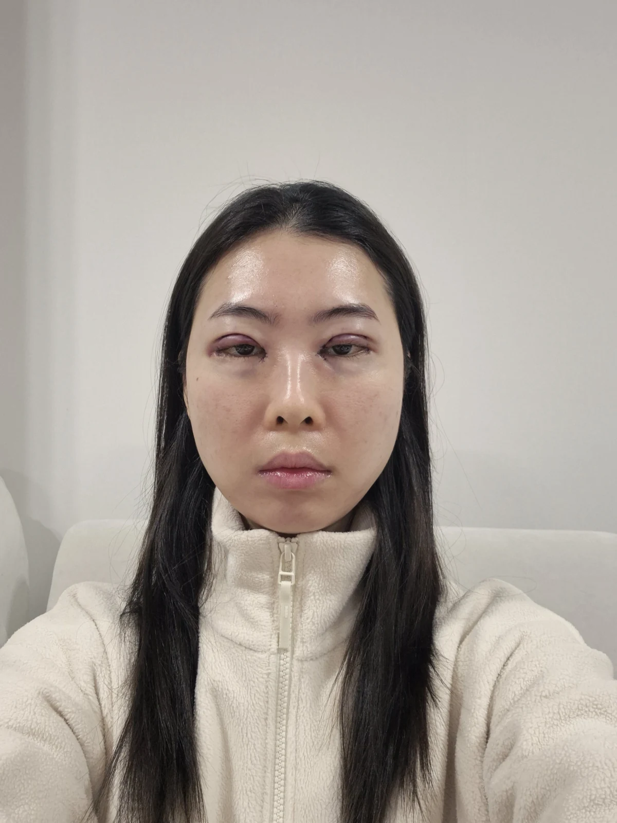 Double-eyelid surgery with canthoplasty and ptosis correction: two-month sequence · Case 044 at Answer Plastic Surgery. Surgery day: front view of the eye area, supplied by Answer Plastic Surgery for case ANS-044.