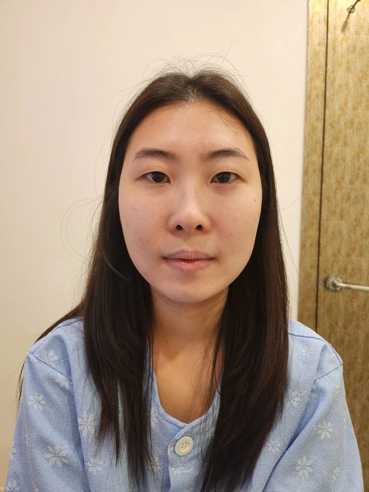 Double-eyelid surgery with canthoplasty and ptosis correction: two-month sequence · Case 044 at Answer Plastic Surgery. Before: front view of the eye area, supplied by Answer Plastic Surgery for case ANS-044.