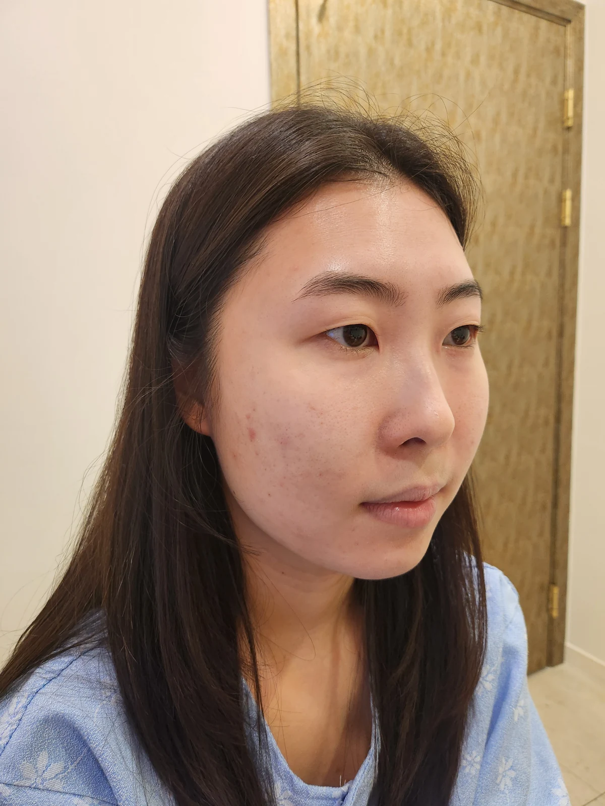 Double-eyelid surgery with canthoplasty and ptosis correction: two-month sequence · Case 044 at Answer Plastic Surgery. Before: angled view of the eye area, supplied by Answer Plastic Surgery for case ANS-044.