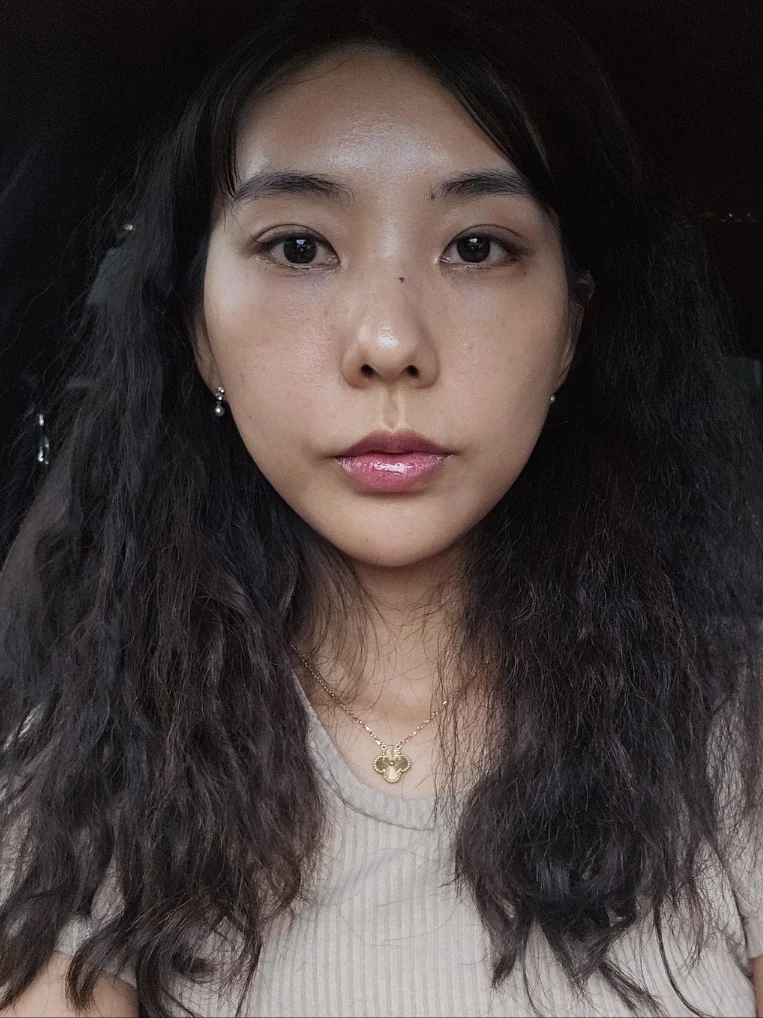Lateral canthoplasty: recovery through three months · Case 045 at Answer Plastic Surgery. Front view 1 month at Answer Plastic Surgery.
