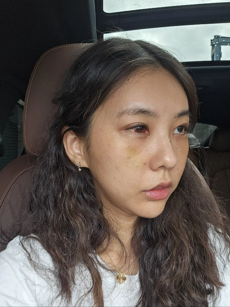 Lateral canthoplasty: recovery through three months · Case 045 at Answer Plastic Surgery. Angled view 1 week at Answer Plastic Surgery.