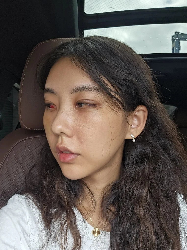 Lateral canthoplasty: recovery through three months · Case 045 at Answer Plastic Surgery. Opposite angled view 1 week at Answer Plastic Surgery.