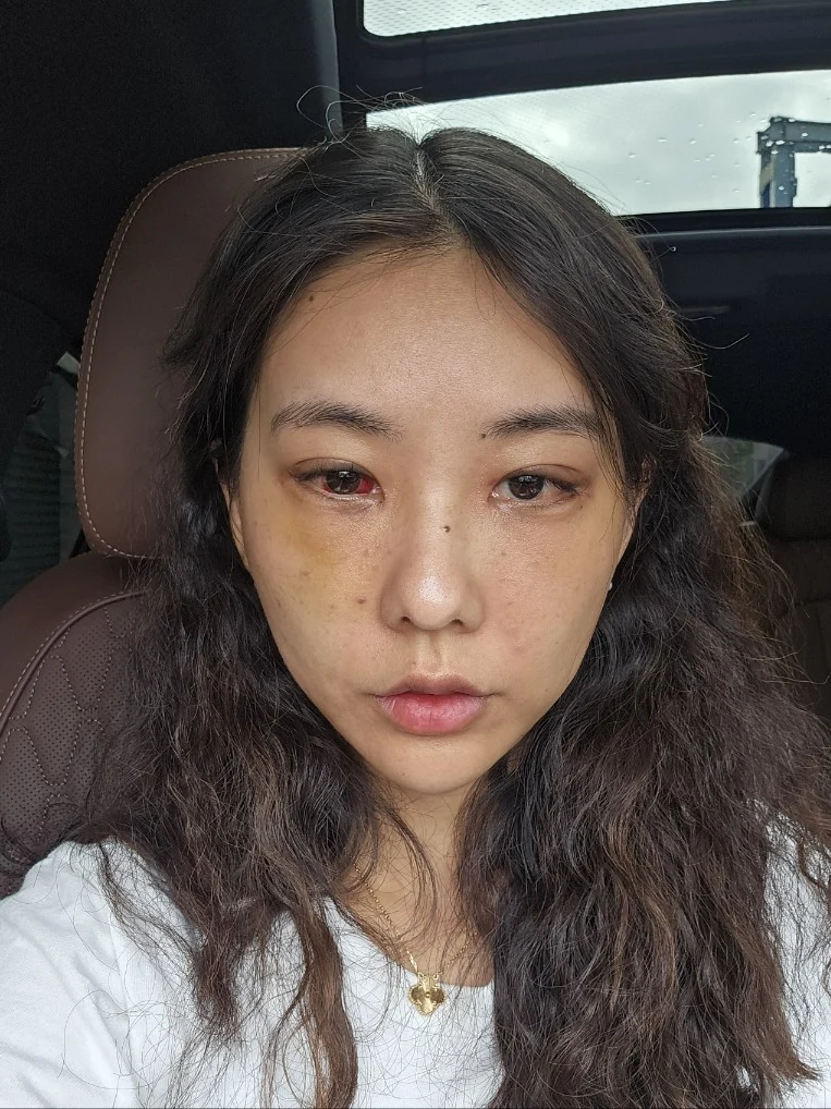 Lateral canthoplasty: recovery through three months · Case 045 at Answer Plastic Surgery. Front view 1 week at Answer Plastic Surgery.
