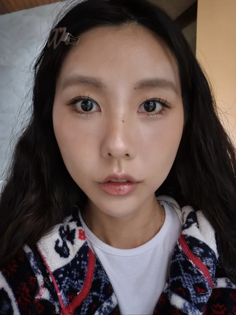 Lateral canthoplasty: recovery through three months · Case 045 at Answer Plastic Surgery. Front view 3 months at Answer Plastic Surgery.
