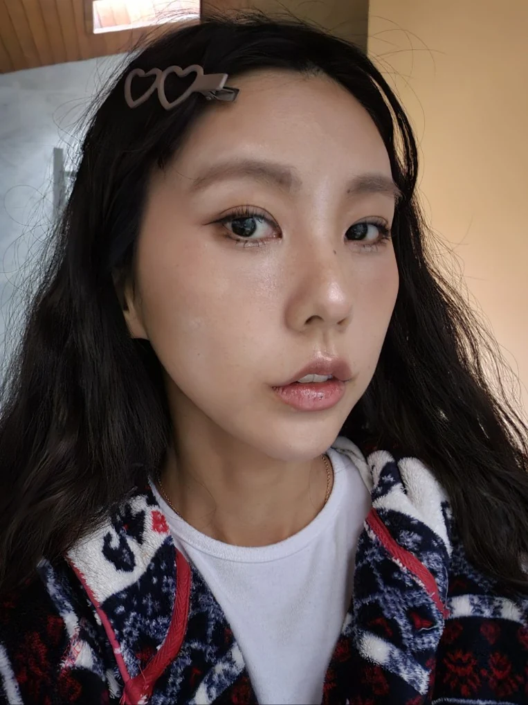 Lateral canthoplasty: recovery through three months · Case 045 at Answer Plastic Surgery. Angled view 3 months at Answer Plastic Surgery.