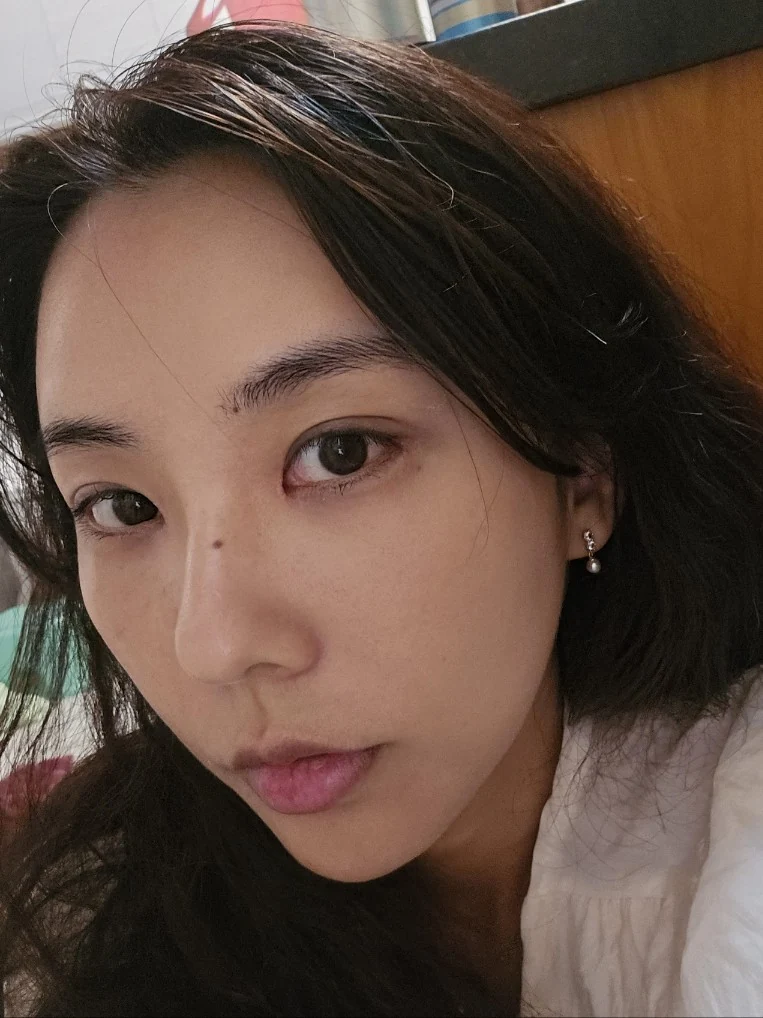 Lateral canthoplasty: recovery through three months · Case 045 at Answer Plastic Surgery. Close angled view 3 weeks at Answer Plastic Surgery.
