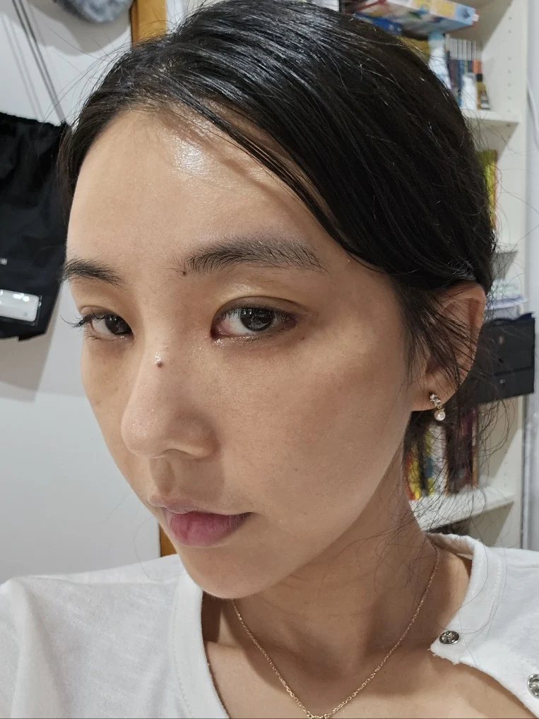 Lateral canthoplasty: recovery through three months · Case 045 at Answer Plastic Surgery. Opposite angled view 3 weeks at Answer Plastic Surgery.