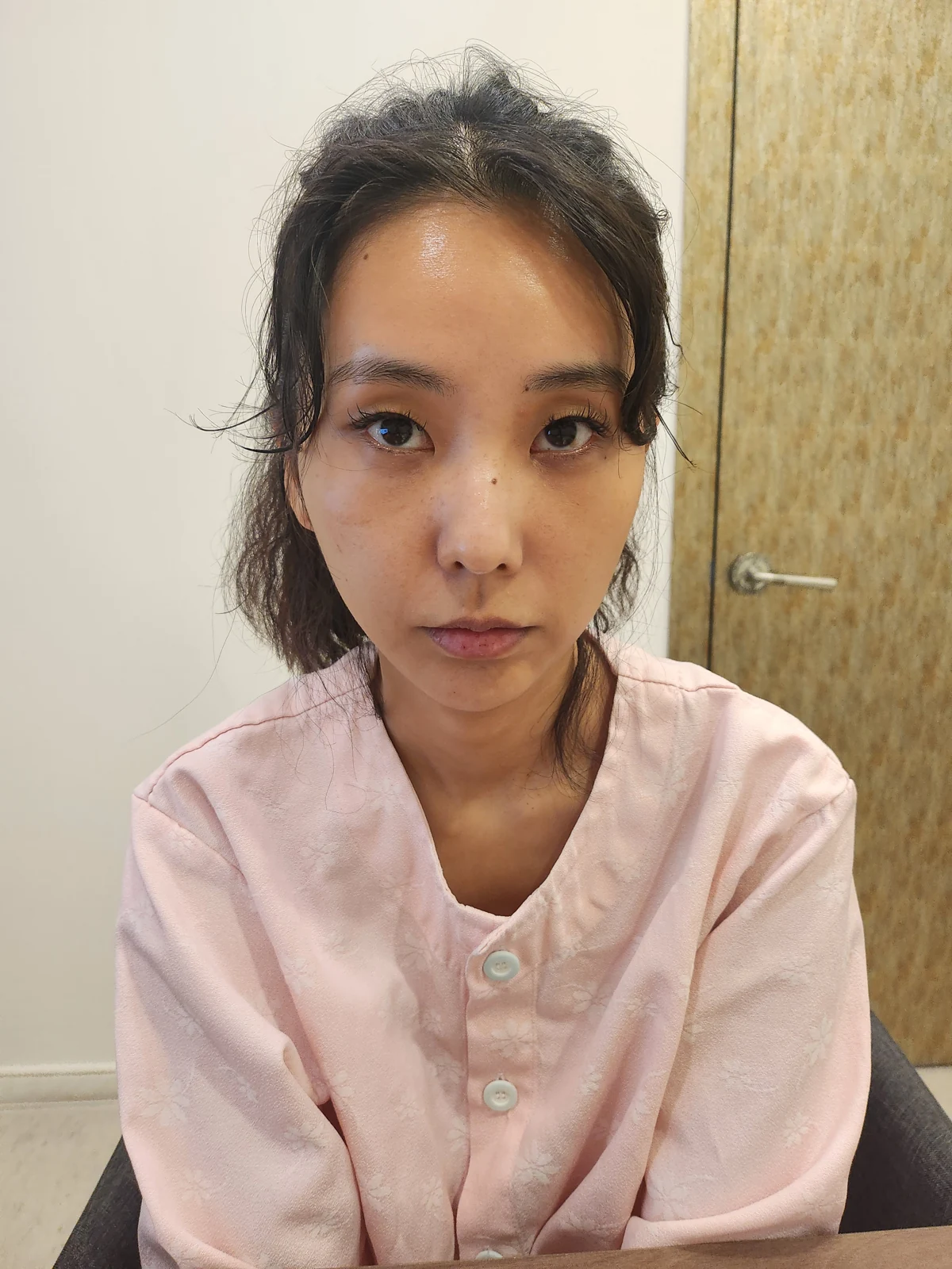 Lateral canthoplasty: recovery through three months · Case 045 at Answer Plastic Surgery. Front view before at Answer Plastic Surgery.