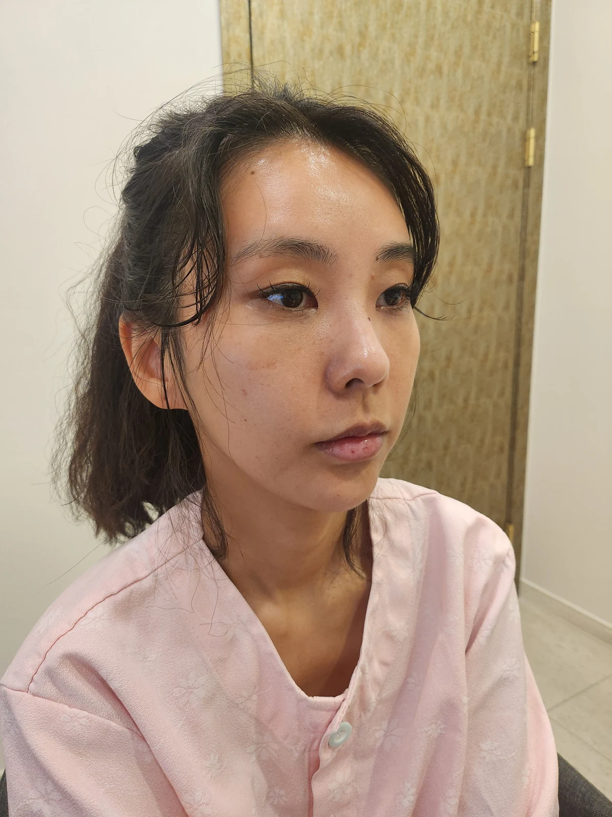 Lateral canthoplasty: recovery through three months · Case 045 at Answer Plastic Surgery. Angled view before at Answer Plastic Surgery.