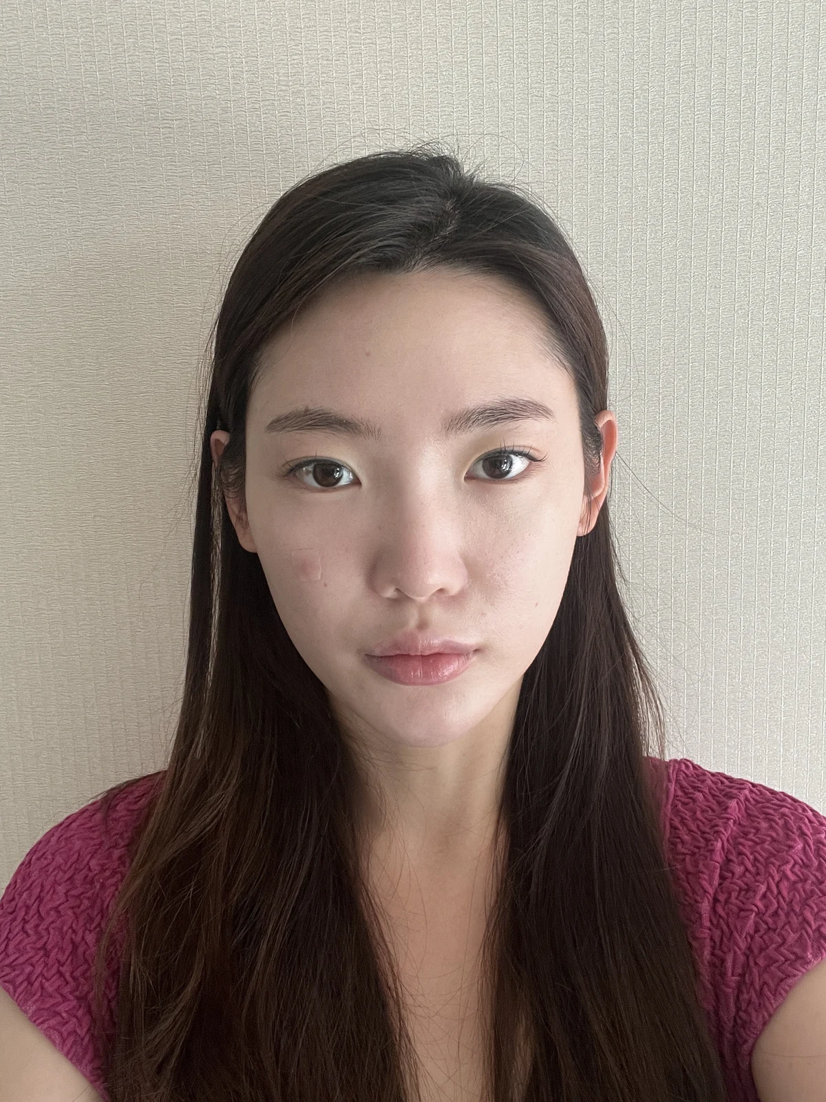 Facial before-and-after photographs through two months · Case 023 at Answer Plastic Surgery. Front view of the face — before at Answer Plastic Surgery.