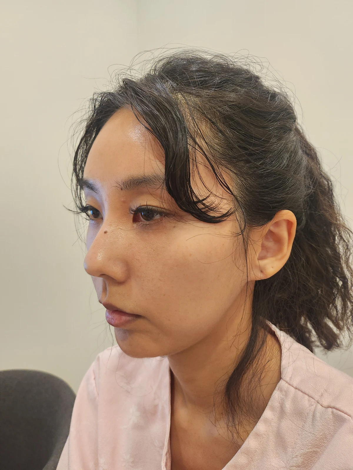 Lateral canthoplasty: recovery through three months · Case 045 at Answer Plastic Surgery. Opposite angled view before at Answer Plastic Surgery.