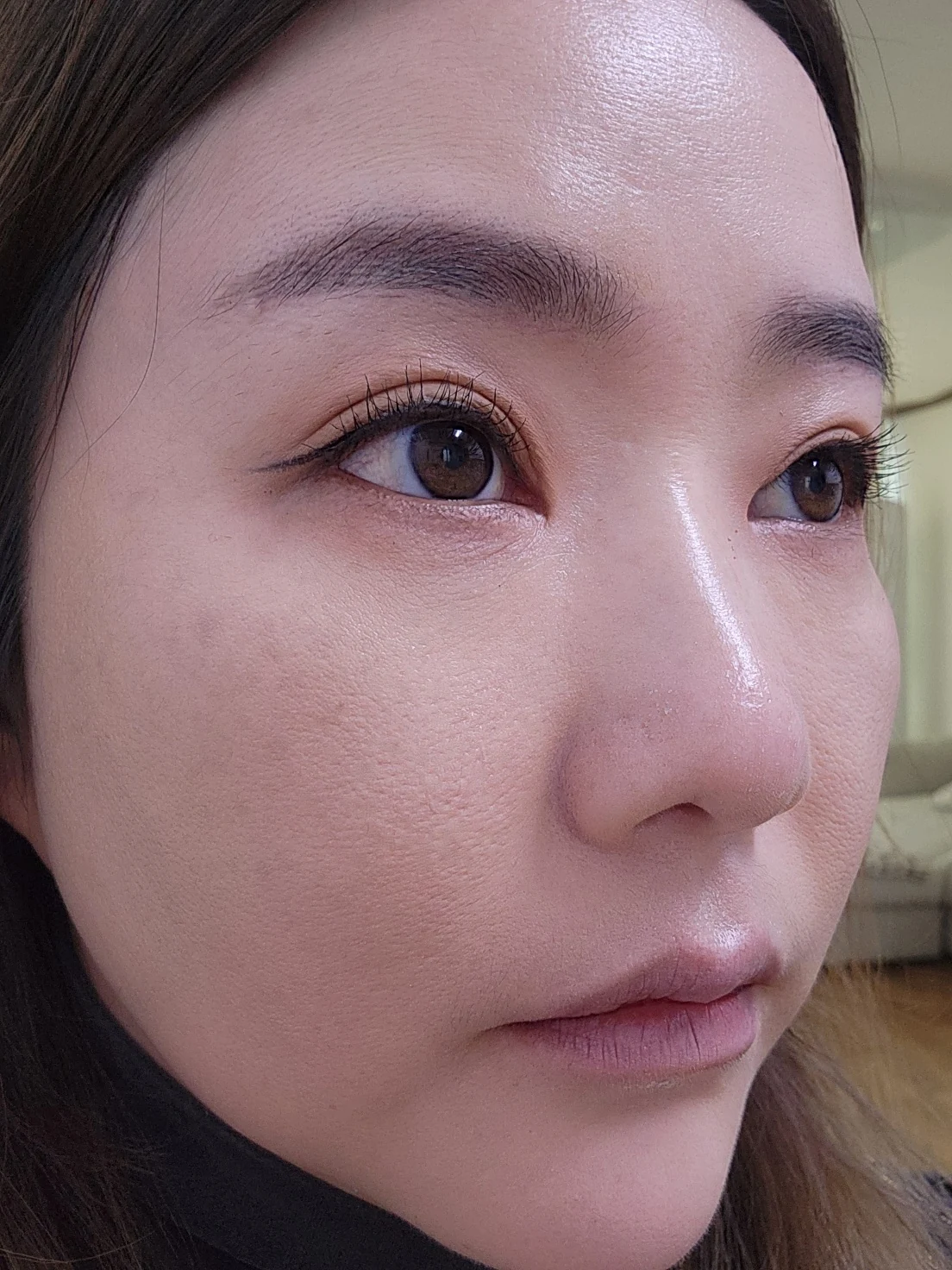 Eye-area surgery: before and recovery through four months · Case 046 at Answer Plastic Surgery. Angled view 1 month at Answer Plastic Surgery.