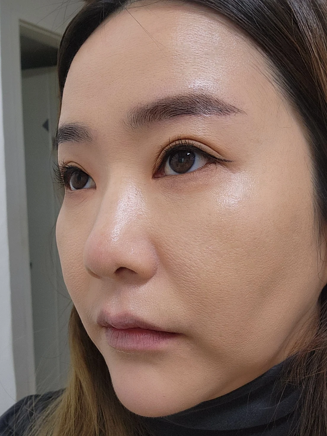 Eye-area surgery: before and recovery through four months · Case 046 at Answer Plastic Surgery. Opposite angled view 1 month at Answer Plastic Surgery.